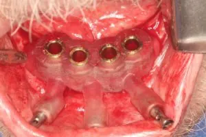 Guided dental implant placement Guided dental implant placement