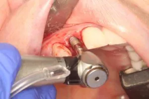 Immediate dental implants Immediate dental implants